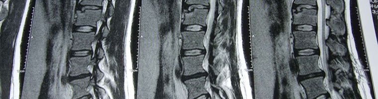Bild zu Die richtige Matratze bei Rückenschmerzen oder Bandscheibenvorfall